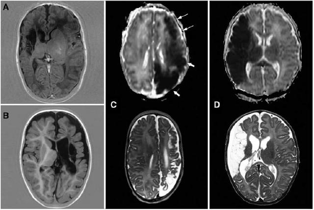 早產(chǎn)新生兒卒中顯示獨特皮層損傷類型