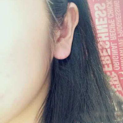 三叉神經(jīng)疼臨床表現(xiàn)及三叉神經(jīng)疼與牙痛的區(qū)分