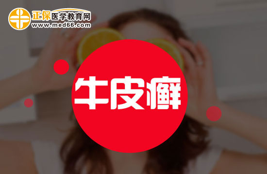 普通不太嚴重的牛皮癬能治好嗎？