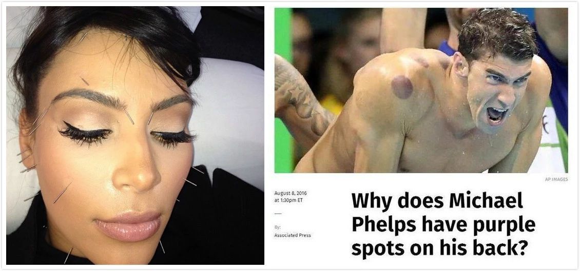 川普正式簽署針灸將納入美國醫(yī)保打臉中醫(yī)黑，美針灸師人數(shù)超過大中國！