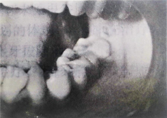 病例分析1 病例分析1