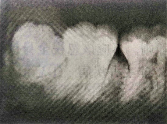 病例分析2 病例分析2