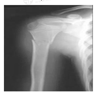 男，45歲，摔傷40分鐘，診斷為