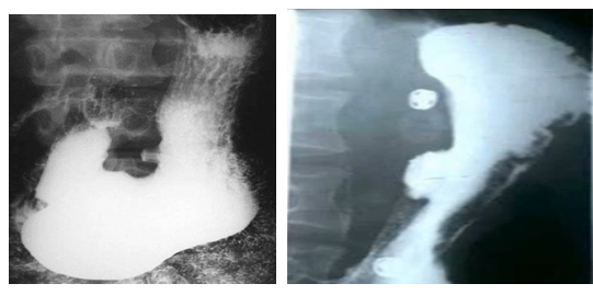 男性，55歲，上腹隱痛約十年，請(qǐng)做出正確診斷