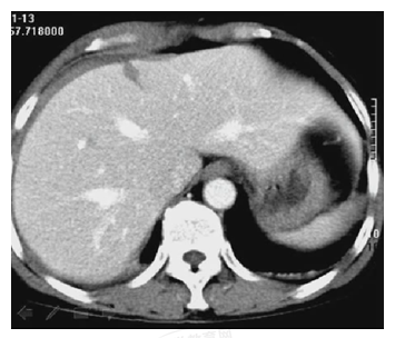 患者，女性，20歲。胸腹部被車(chē)撞傷5小時(shí)。診斷為