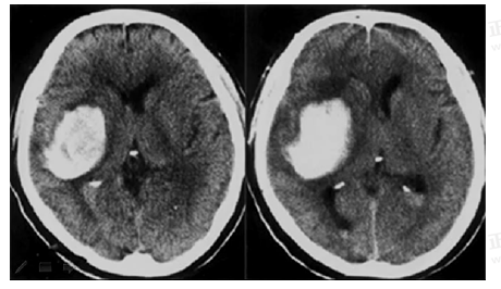 男55歲，左側(cè)肢體偏癱4小時(shí)，有高血壓史，診斷為