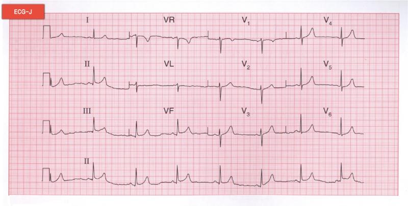 心動(dòng)過緩 心動(dòng)過緩