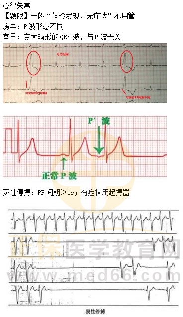 心律失常 心律失常