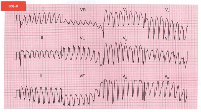 心電圖診斷1 心電圖診斷1