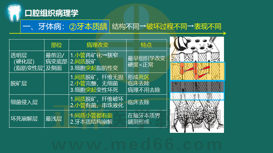 牙本質(zhì)齲的病理表現(xiàn) 牙本質(zhì)齲的病理表現(xiàn)