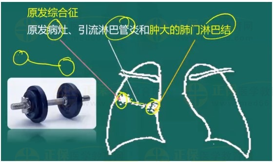 肺結(jié)核原發(fā)綜合征