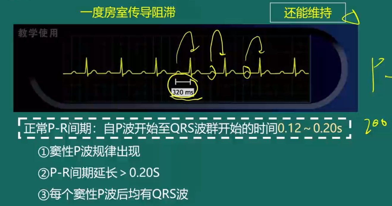 房室傳導(dǎo)阻滯-1 房室傳導(dǎo)阻滯-1
