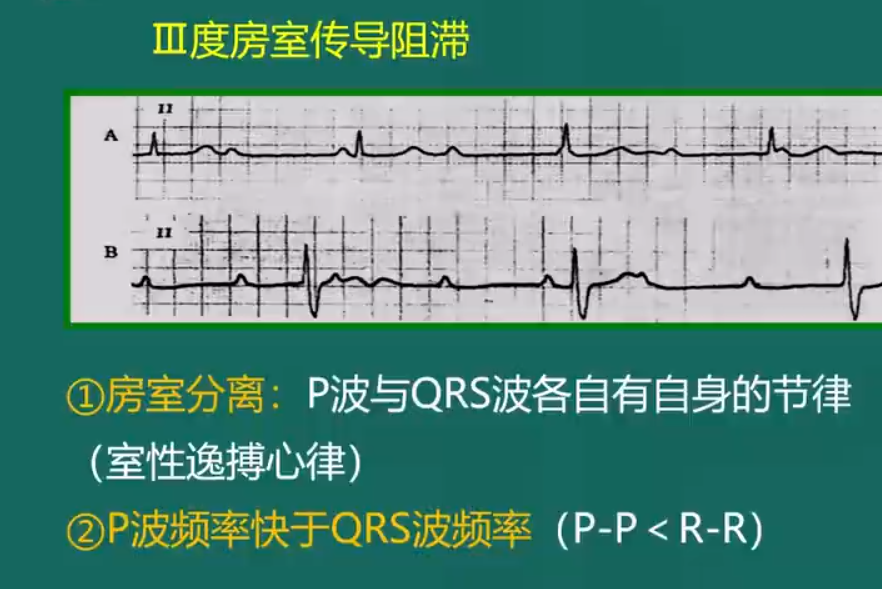 房室傳導(dǎo)阻滯-4 房室傳導(dǎo)阻滯-4