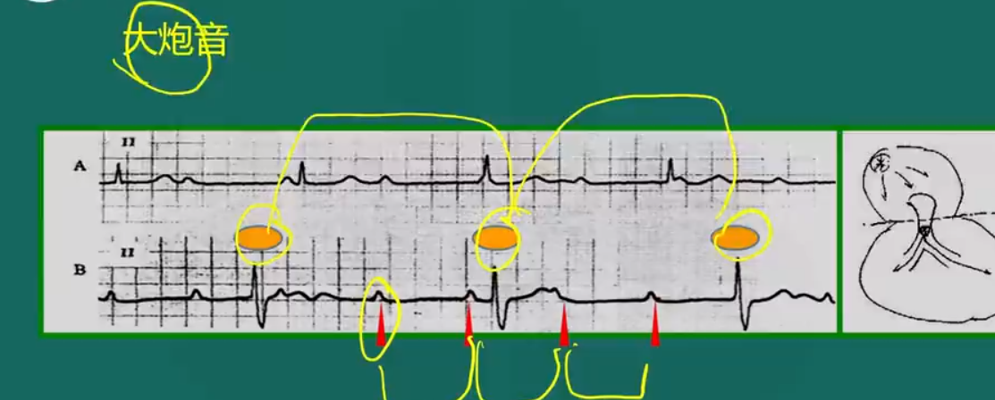 房室傳導(dǎo)阻滯-5 房室傳導(dǎo)阻滯-5