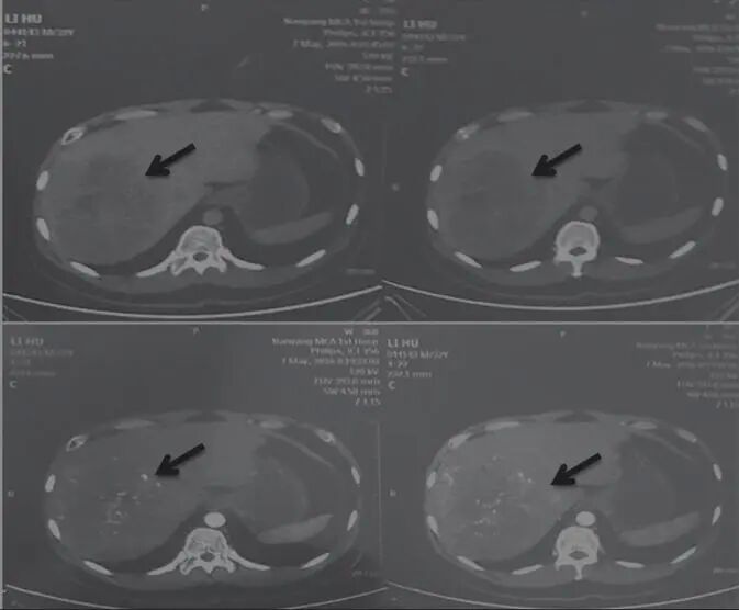圖1 舒達(dá)少陽防治腫瘤驗案初診CT結(jié)果