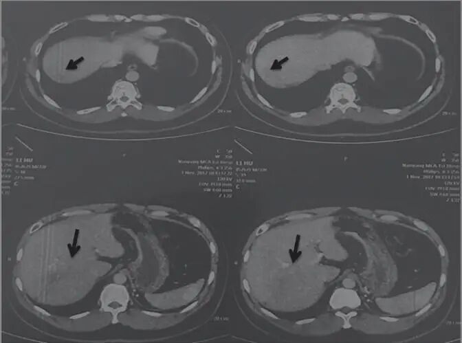 圖2 舒達(dá)少陽防治腫瘤驗案2017年11月1日CT結(jié)果