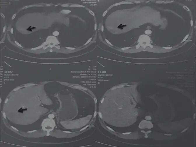 圖3 舒達(dá)少陽防治腫瘤驗案2018年3月30日CT結(jié)果